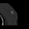 SPORK, NICO - 22.03.1976 - 02.08.2022 - CT obere Extremität - 18:01:46